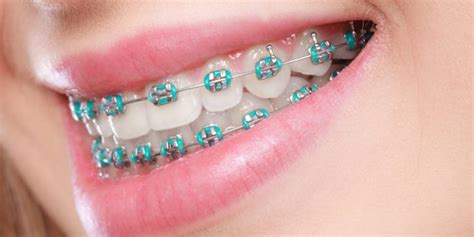 what is omni metal dental brackets|orthopaedic brackets.